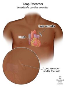 24543 loop recorder illustration.ashx