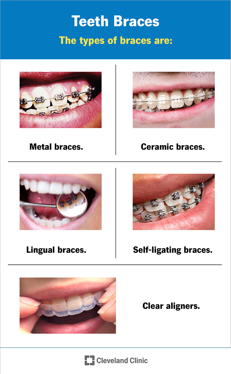 I diversi tipi di apparecchi sono allineatori metallici, ceramici, linguali, autoleganti e trasparenti.