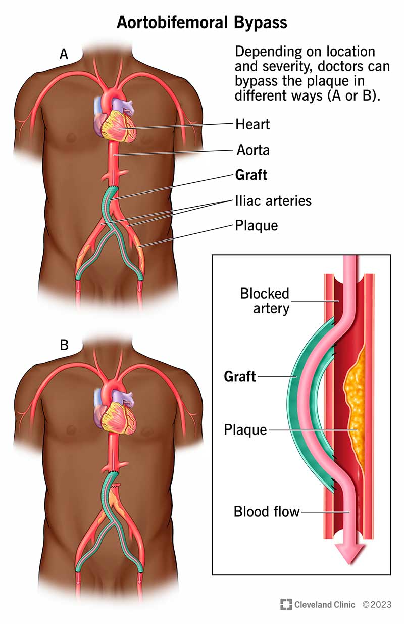 Illustrazione che mostra la posizione di un innesto di bypass aortobifemorale.
