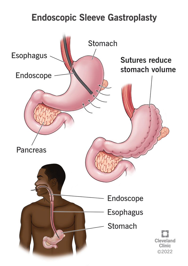 La gastroplastica endoscopica con manica riduce il volume dello stomaco chiudendo una porzione con punti di sutura.