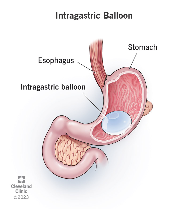 24773 intragastric balloon