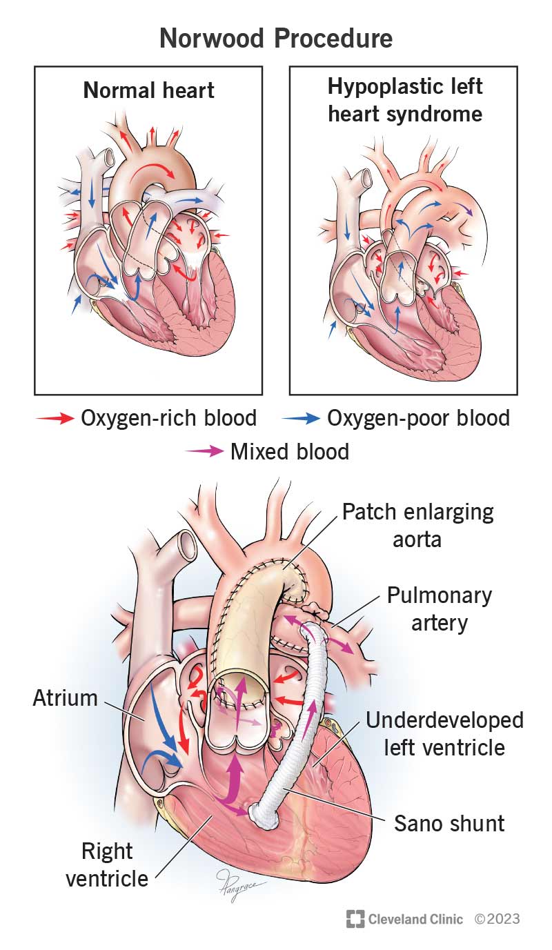 Una procedura di Norwood migliora la circolazione sanguigna nei bambini con sindrome del cuore sinistro ipoplastico (HLHS).