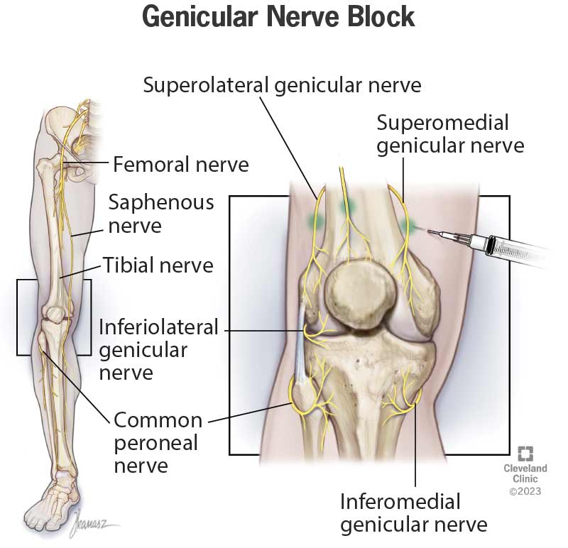 24823 genicular nerve block