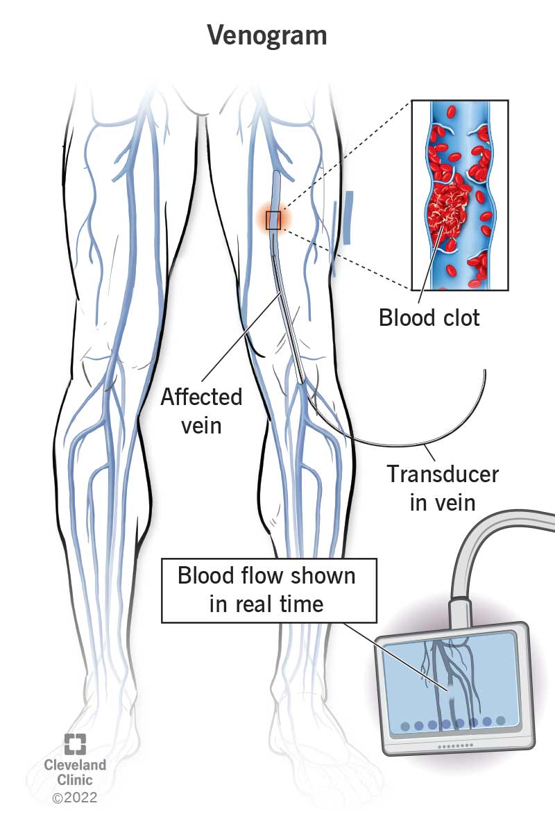 Illustrazione che mostra le vene delle gambe di una persona insieme a un richiamo che evidenzia la presenza di un coagulo di sangue nella coscia.