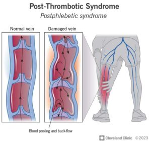 24936 post thrombotic syndrome illustration.ashx