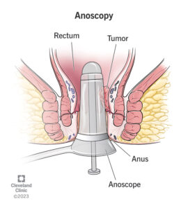 24993 anoscopy