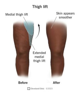 25012 thigh lift thighplasty