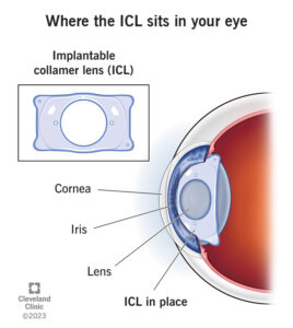 25050 icl surgery