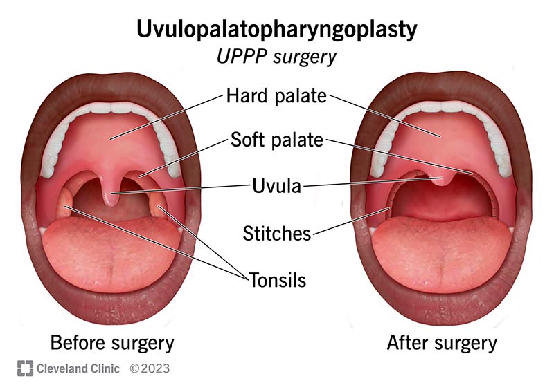25059 uvulopalatopharyngoplasty