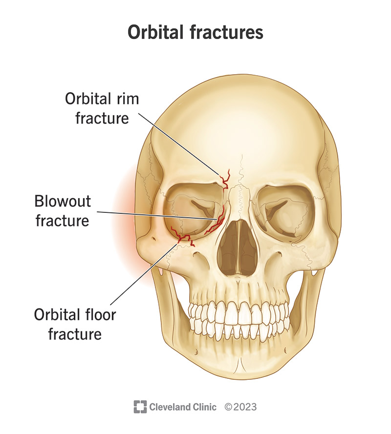25075 orbital fractures