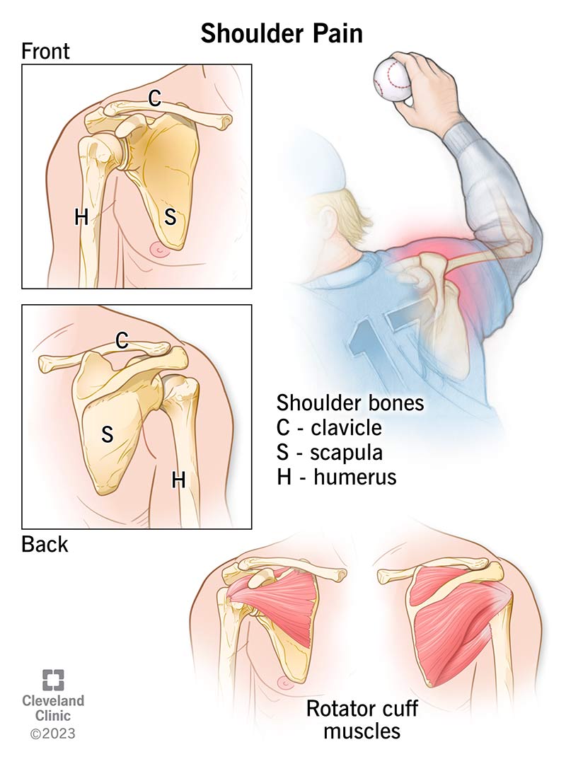 Le ossa e i muscoli all'interno e attorno all'articolazione della spalla che possono causare dolore alla spalla.
