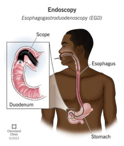 25126 endoscopy