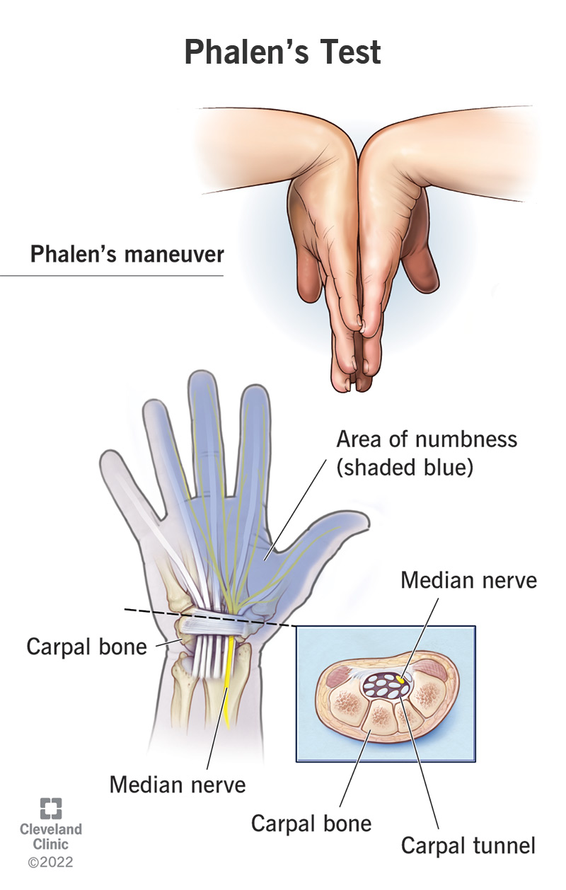 Un'illustrazione della manovra del Phalen e delle parti della mano e del polso colpite dalla sindrome del tunnel carpale