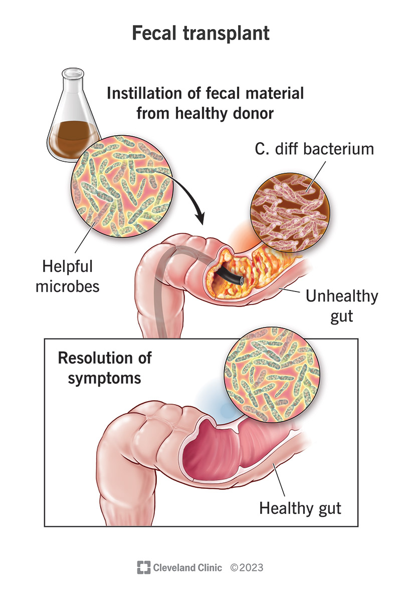 Un trapianto fecale preleva un piccolo campione di feci da un colon sano e lo inserisce in un colon malato.