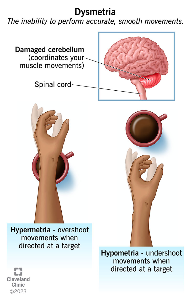 Dismetria: una mano che supera (ipermetria) e non raggiunge (ipometria) la mano che raggiunge una tazza di caffè.