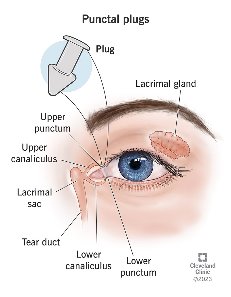 I tappi Punctal possono essere inseriti in un punctum, una piccola apertura all'interno della palpebra che drena il liquido lacrimale dagli occhi.
