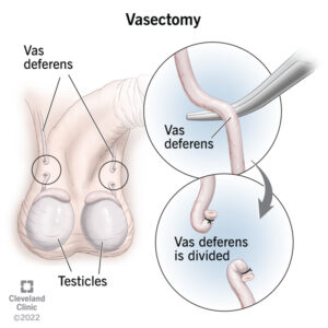 4423 vasectomy