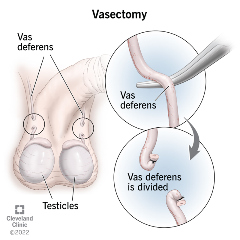 4423 vasectomy