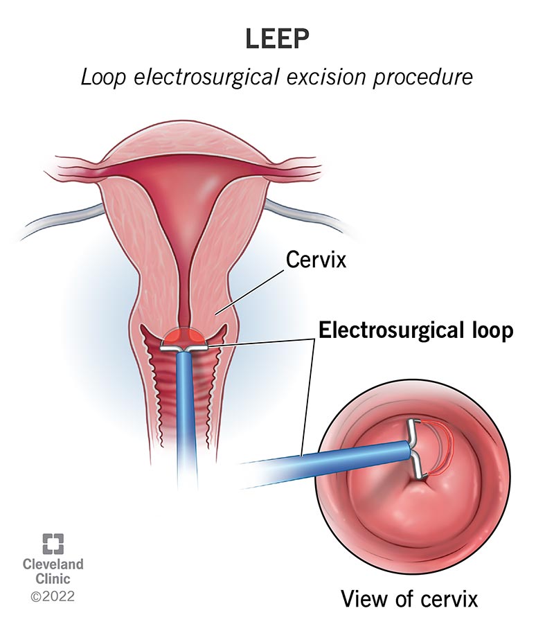 4711 loop electrosurgical excision procedure leep 1