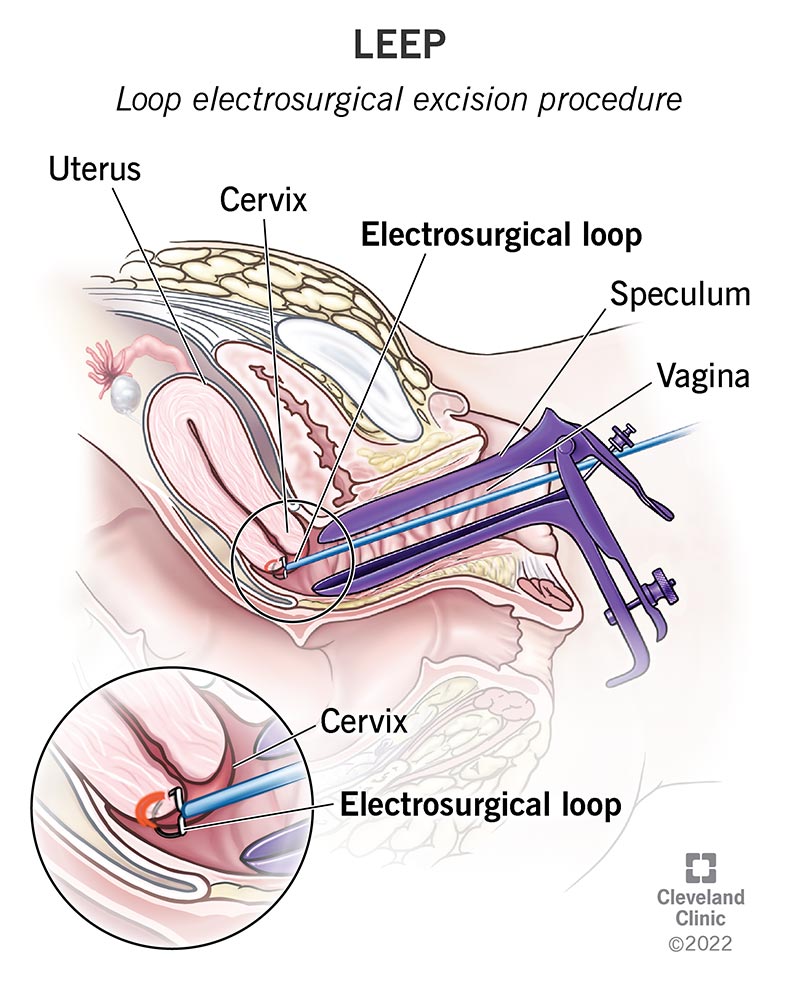 Uno speculum allarga la vagina in modo che il filo LEEP possa passare attraverso il canale vaginale e raggiungere la cervice.