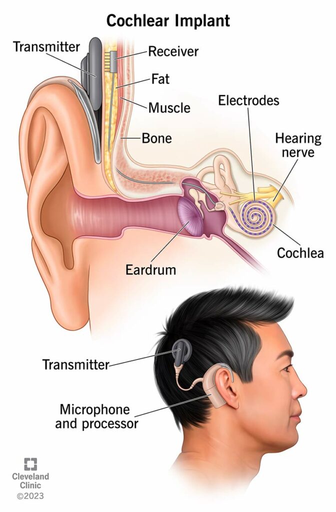 4806 cochlear implant