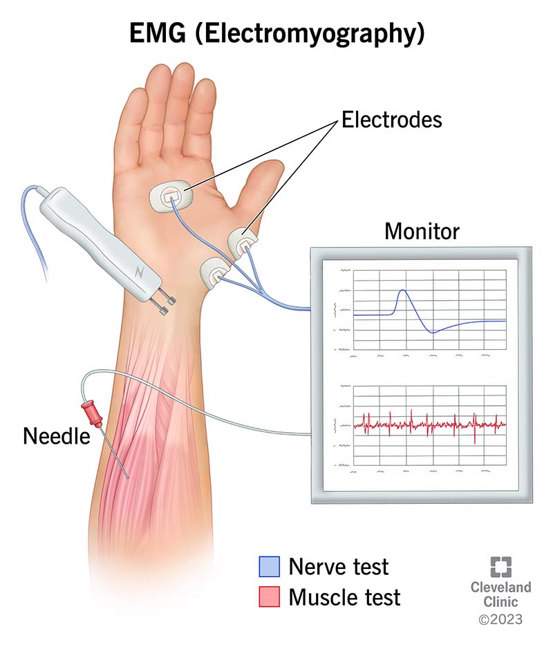 4825 electromyography