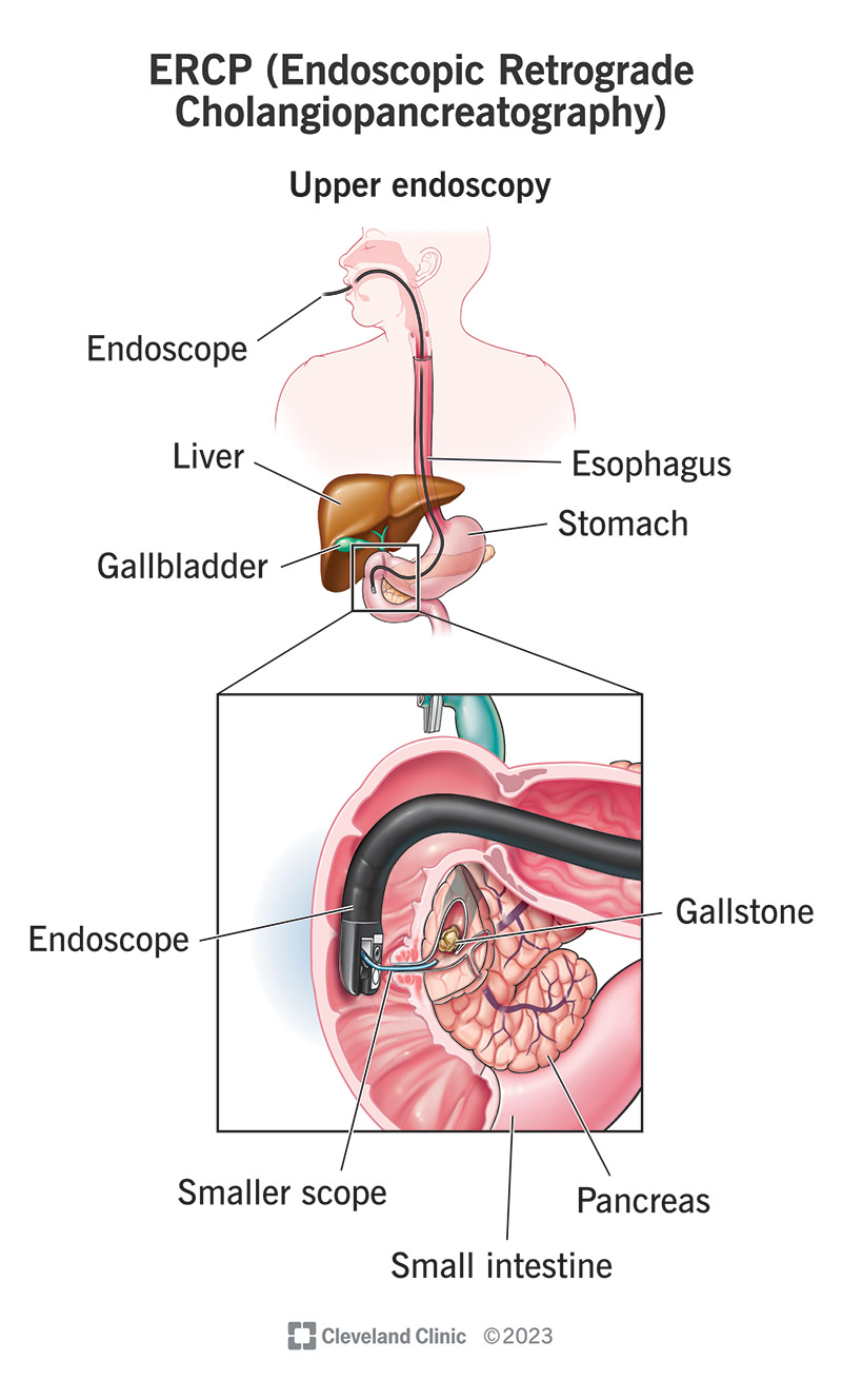 Un ERCP prevede il passaggio di un piccolo dispositivo in gola e attraverso lo stomaco, fino al tratto biliare.