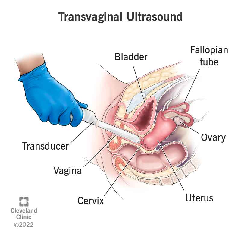 4993 transvaginal ultrasound