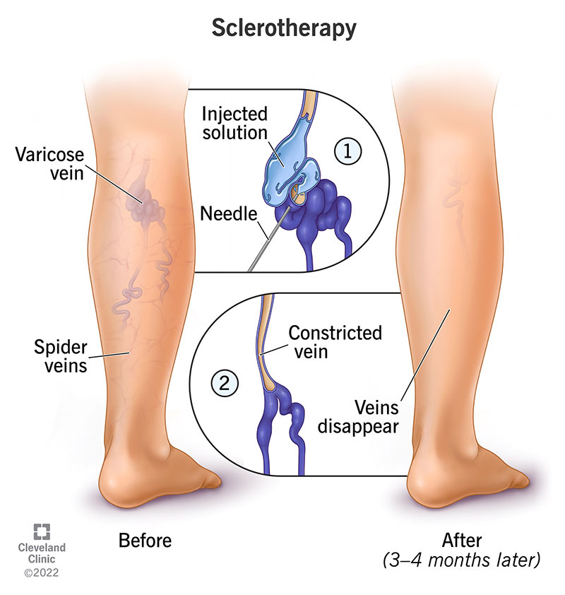 6763 sclerotherapy
