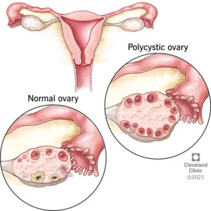 8316 polycystic ovary syndrome pcos