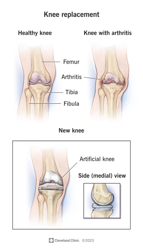 8512 knee replacement
