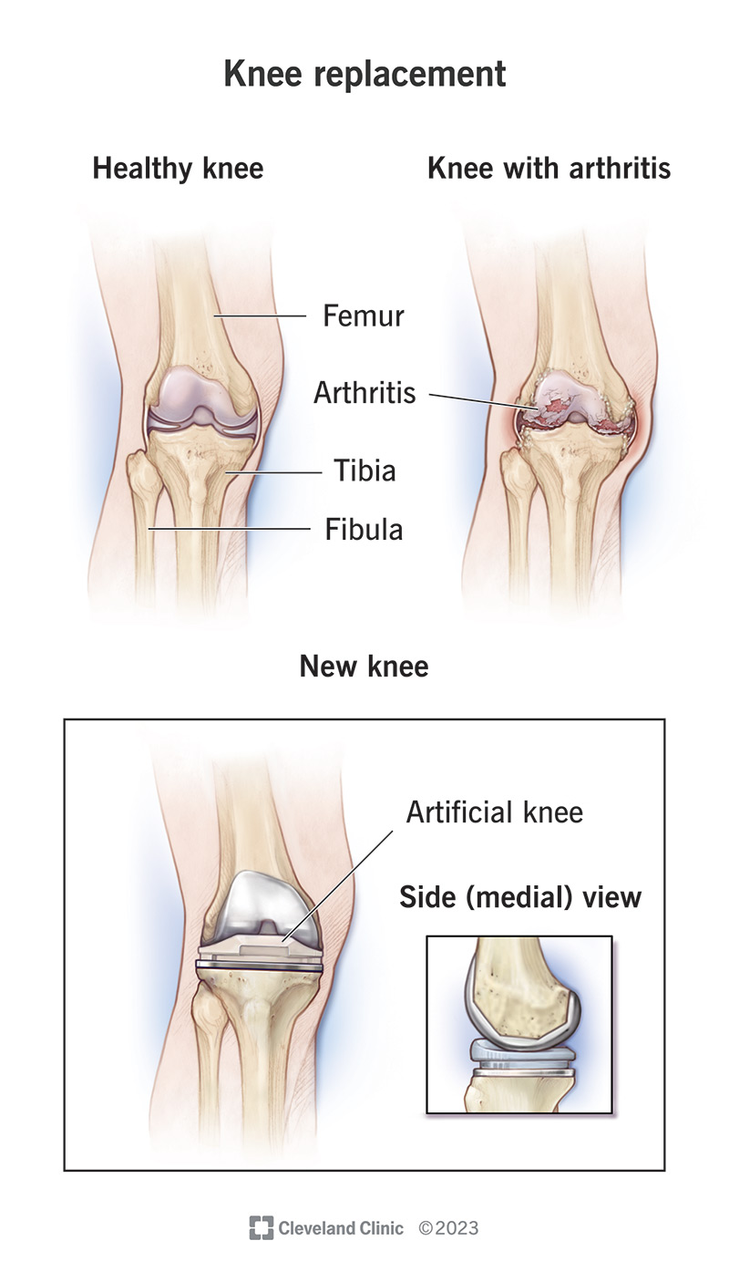 Un ginocchio sano, un ginocchio con artrite e un ginocchio dopo un intervento di sostituzione del ginocchio
