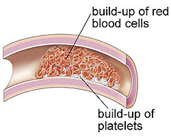 blood clotting