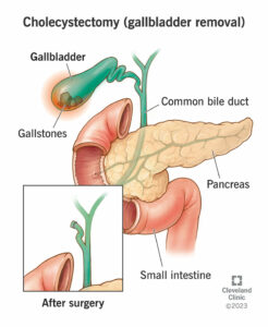 cholecystectomy gallbladder removal