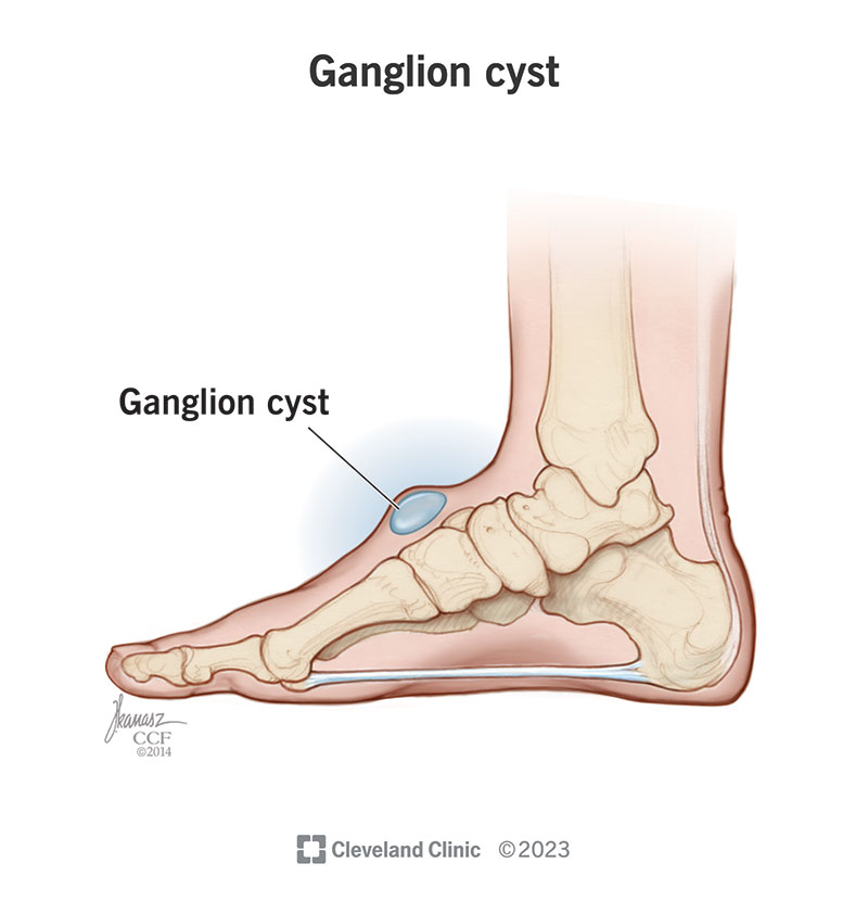 ganglion cyst