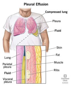 pleural effusion