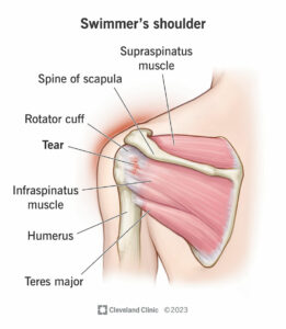 swimmers shoulder