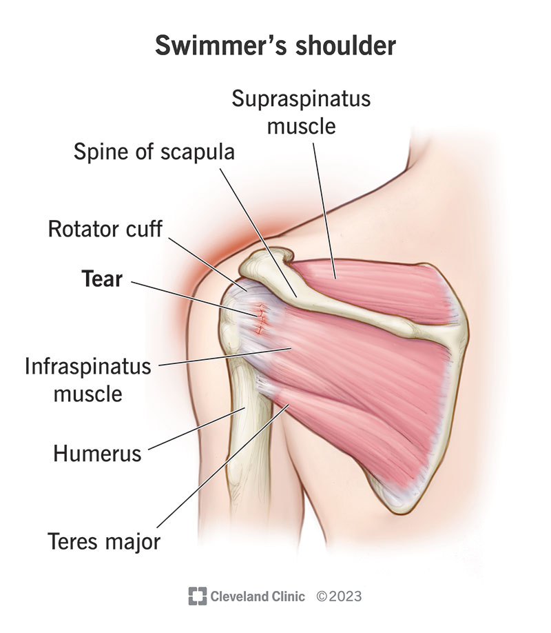 swimmers shoulder