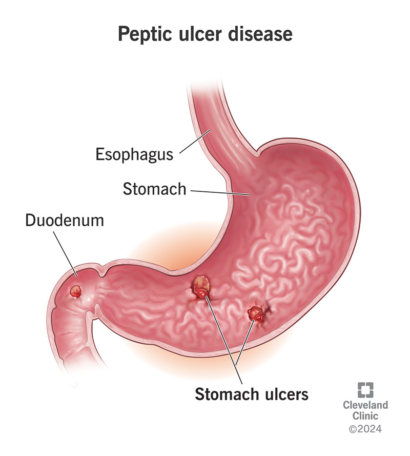 10350 peptic ulcer disease