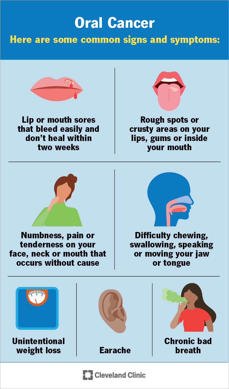 Sintomi del cancro orale in senso orario dall'alto a sinistra piaghe della bocca punti ruvidi dolore difficoltà a masticare perdita di peso mal d'orecchi alito cattivo.