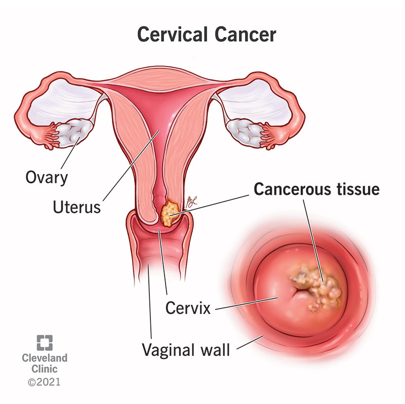 12216 cervical cancer