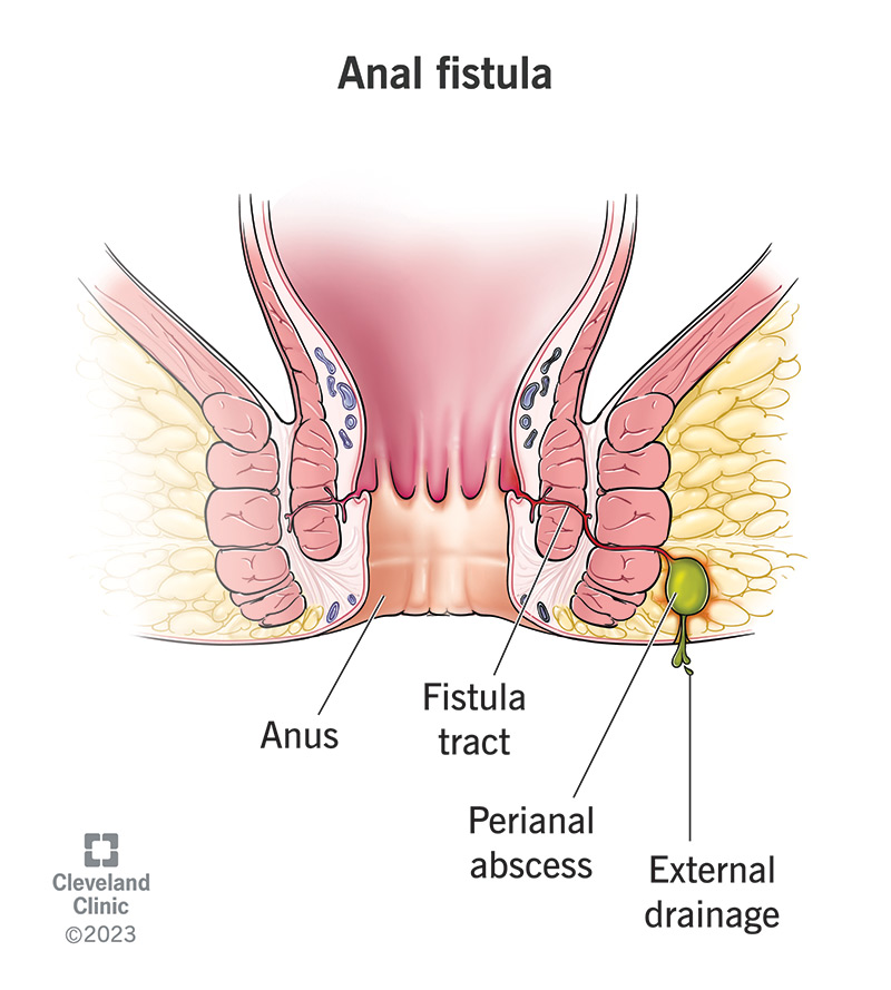 14466 anal fistula