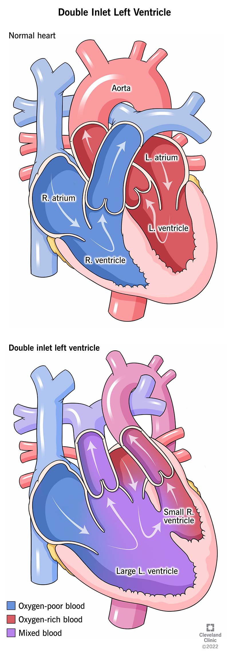 Con il ventricolo sinistro a doppia entrata, entrambi gli atri del bambino forniscono sangue al ventricolo sinistro.