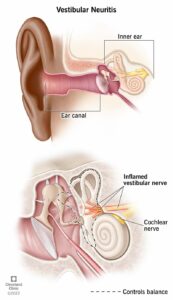 15227 vestibular neuritis