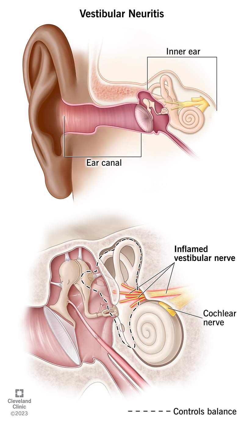 Sezione trasversale dell'orecchio interno che evidenzia un nervo vestibolare infiammato.
