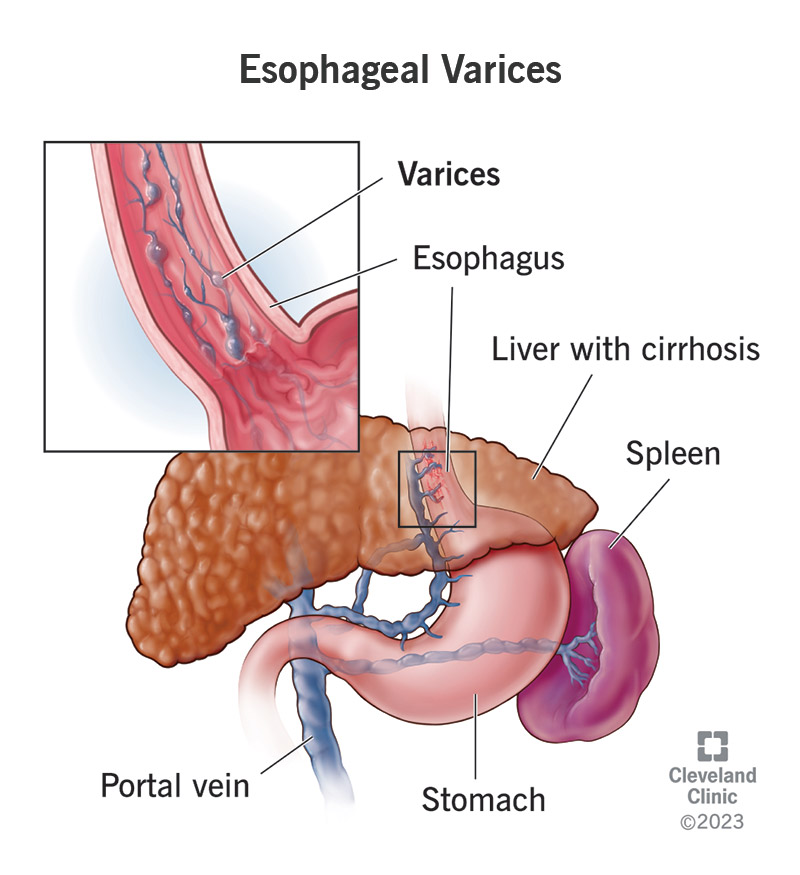15429 esophageal varices