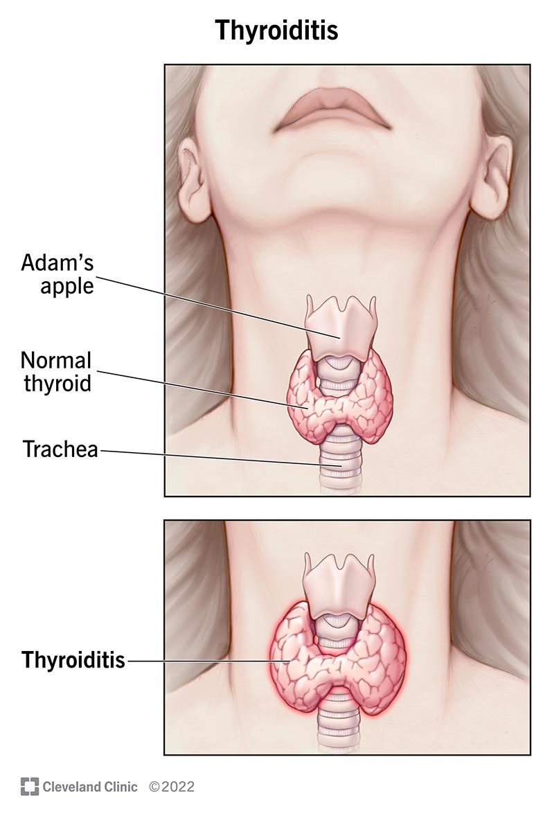 Illustrazione di una tiroide normale che avvolge la trachea sotto il pomo d'Adamo e di una tiroidite come una tiroide ingrossata