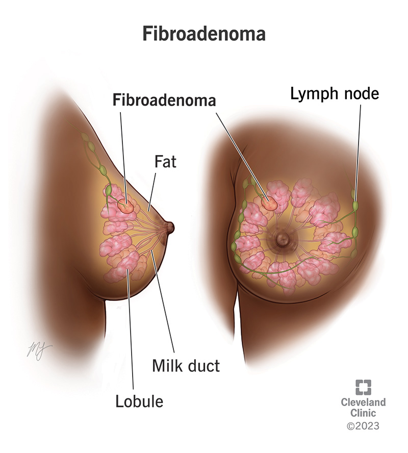 15690 fibroadenomas of the breast