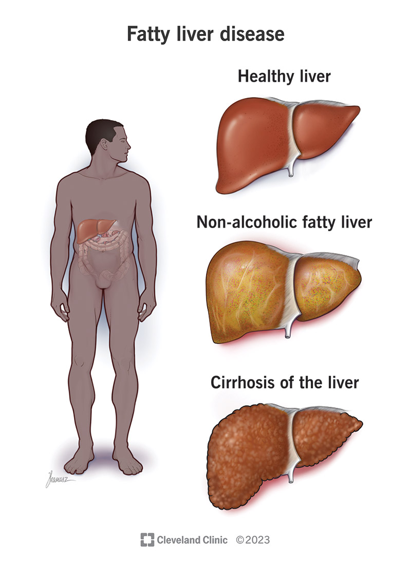 La progressione della malattia epatica: inizia con un fegato sano, poi con un fegato grasso e infine con la cirrosi