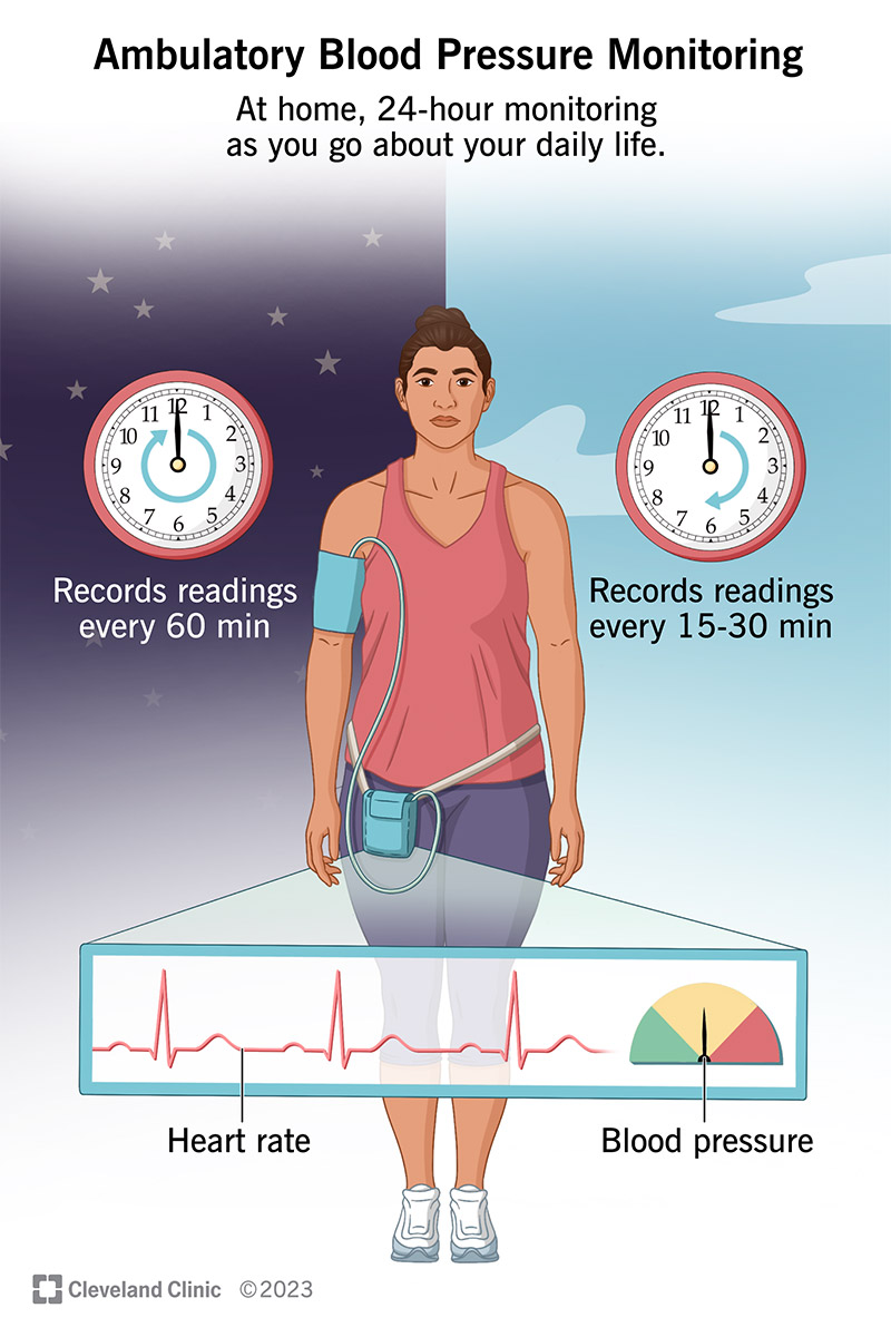 Illustrazione di una persona che indossa un misuratore di pressione sanguigna ambulatoriale.